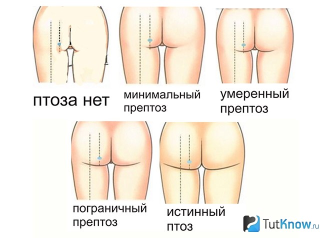 Птоз