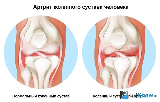 Артрит коленного сустава