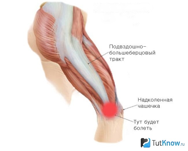 Схематическое изображение подвздошно-большеберцового тракта