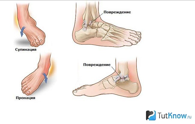 Механизм травмы голеностопа