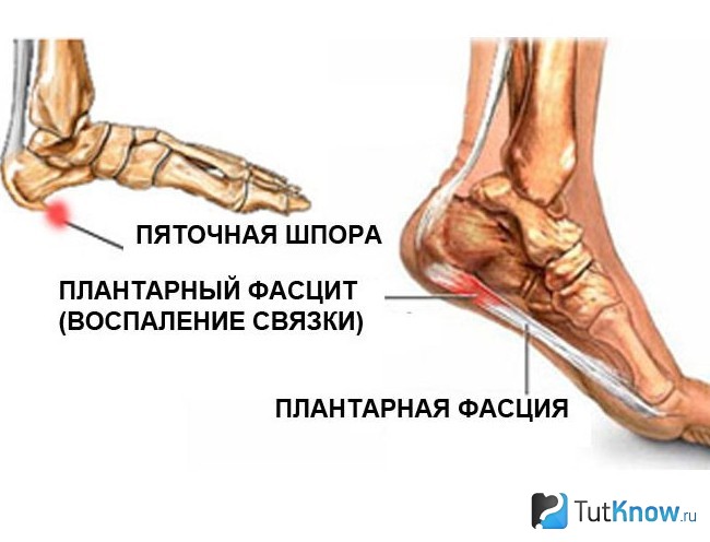 Схематическое изображение подошвенного фасциита