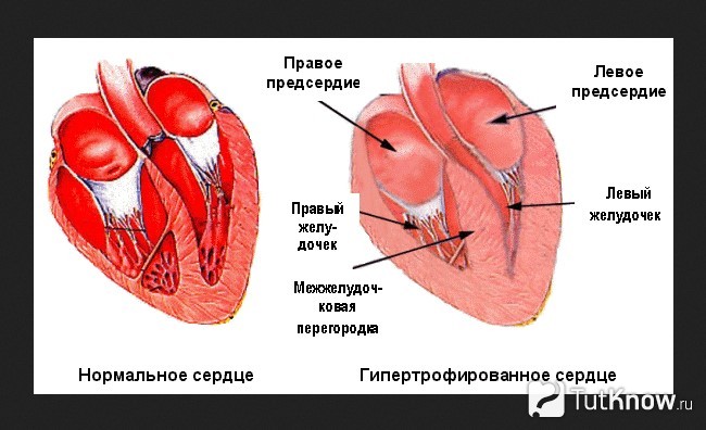 Схематическое изображение нормального и гипертрофированного сердца