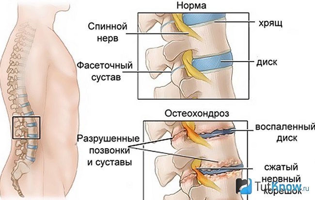 Сравнение здорового и больного позвоночника