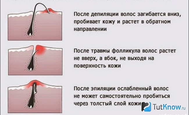 Схема врастания волоска в кожу