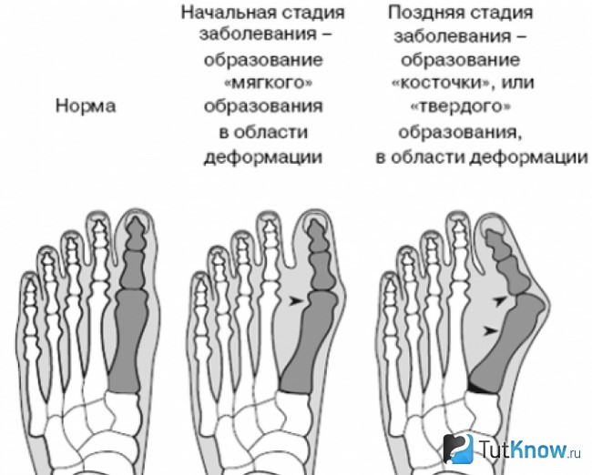 Схематическое изображение разных стадий развития болезни