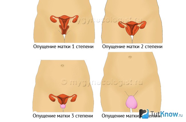 Стадии опущения матки