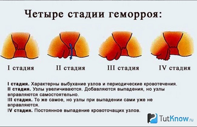 Стадии геморроя