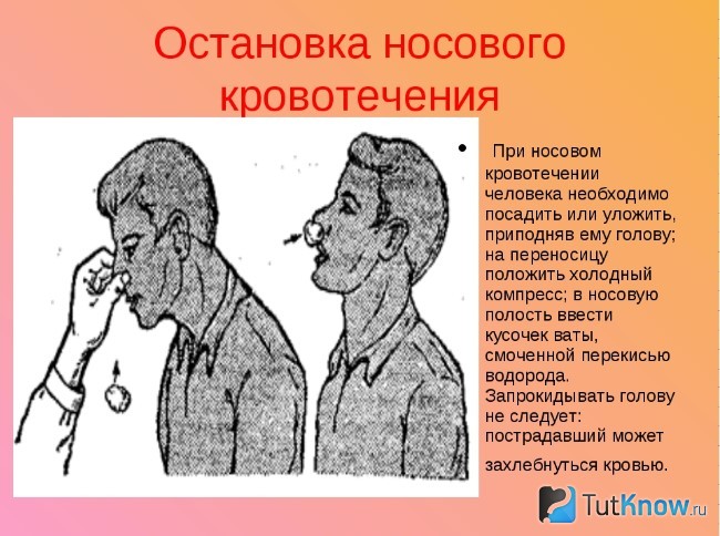 Первая помощь при носовом кровотечении