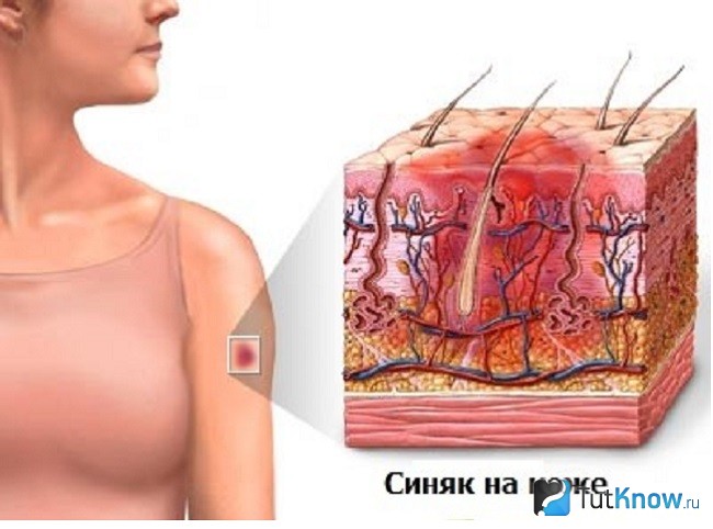 Образование синяка на коже