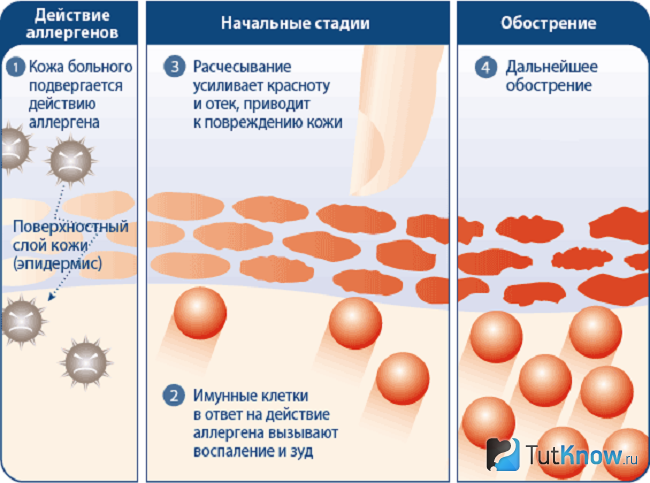 Механизм проявления аллергии