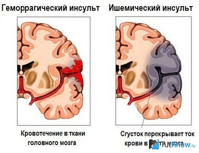 Разновидности инсульта