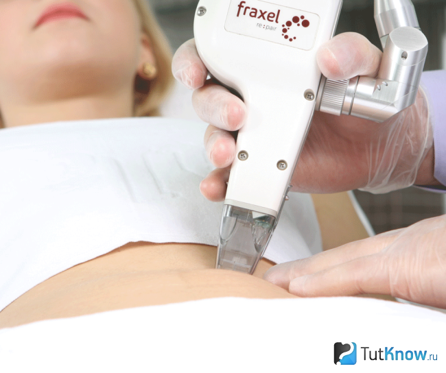 Лечение растяжек на коже лазером