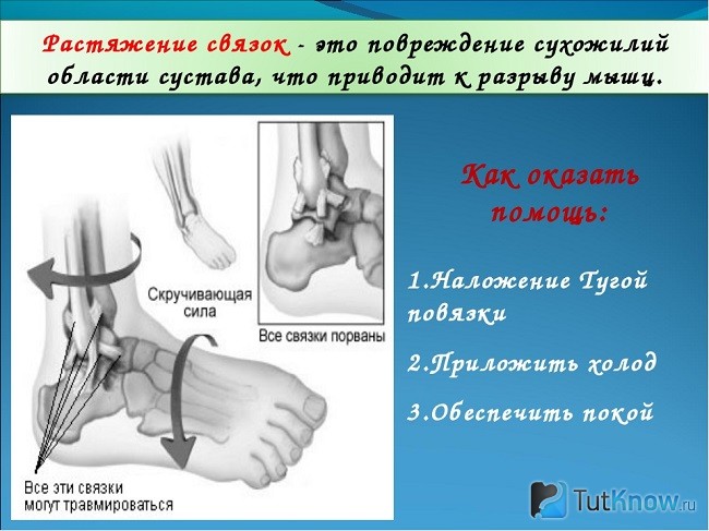 Определение растяжения связок и оказание первой помощи