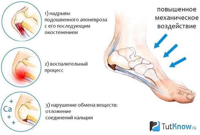 Причины болей в пятках