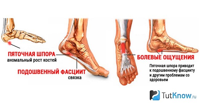Схематическое изображение подошвенного фасциита
