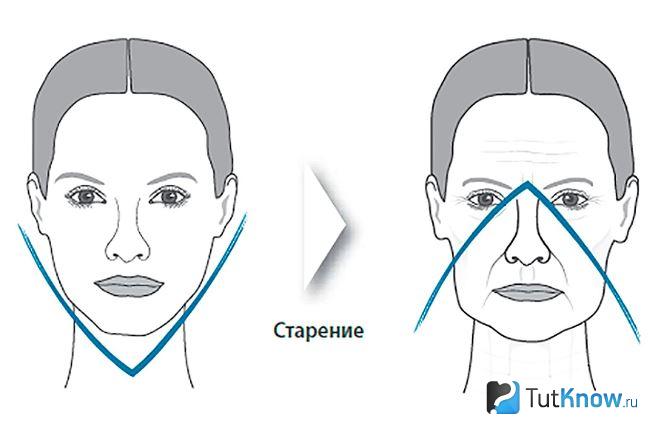 Формирование бульдожьих щечек