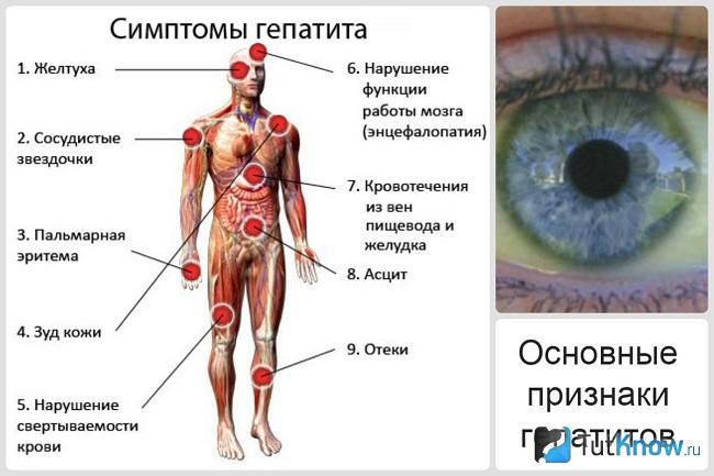 Схематическое изображение симптомов гепатита C