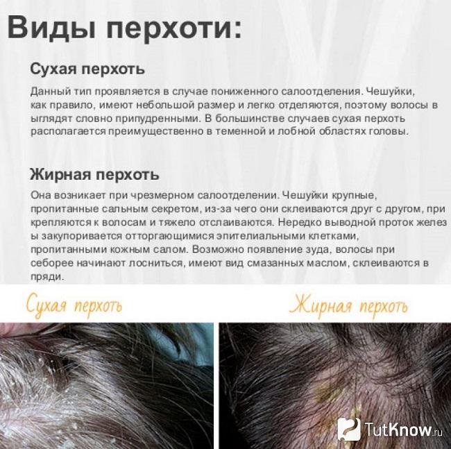Описание видов перхоти