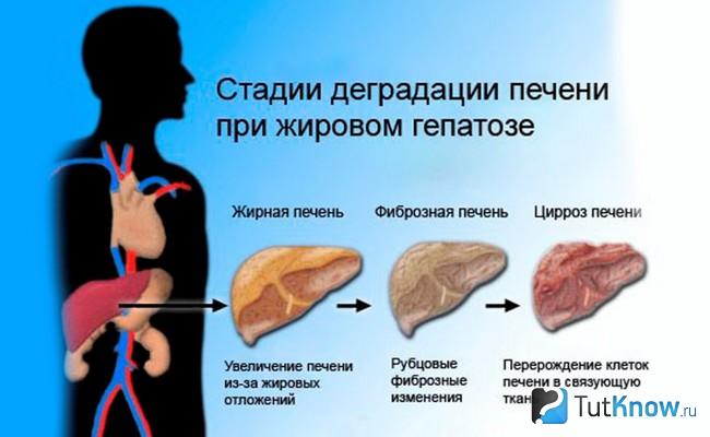 Стадии развития жирового гепатоза