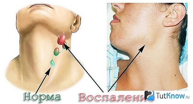 Основной симптом болезни Ходжкина