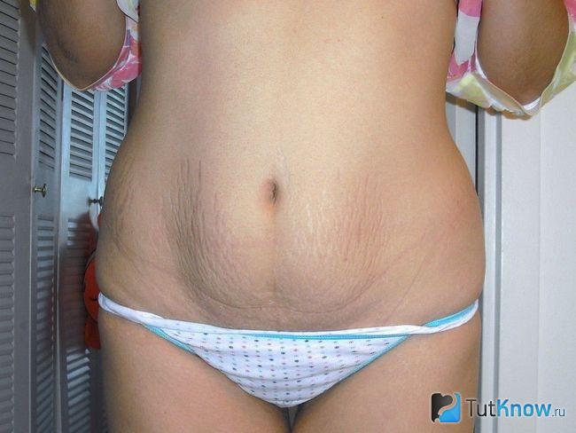 Дряблая кожа на животе девушки