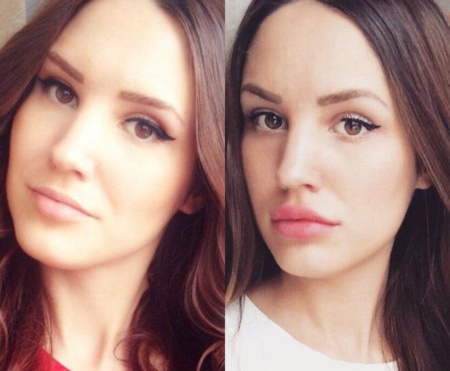 Губы до и после применения мезонитей