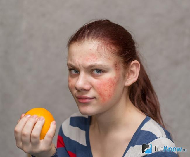 Аллергия на цитрусовые