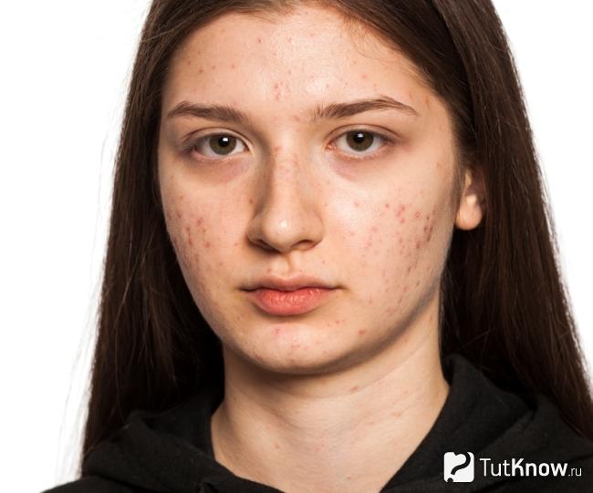 Прыщи как показание к применению маски с желатином и углем