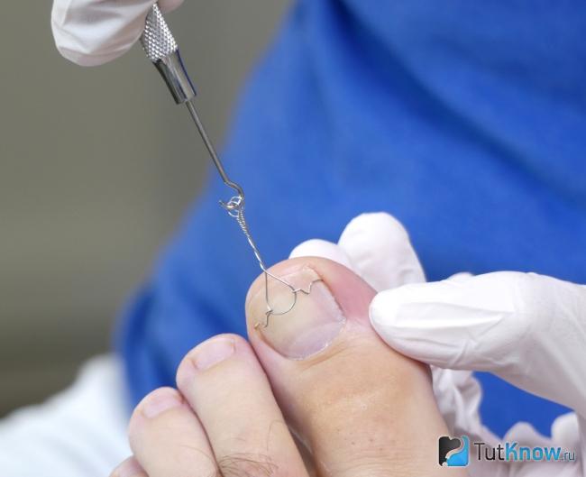 Ортопедическая скоба для коррекции вросшего ногтя