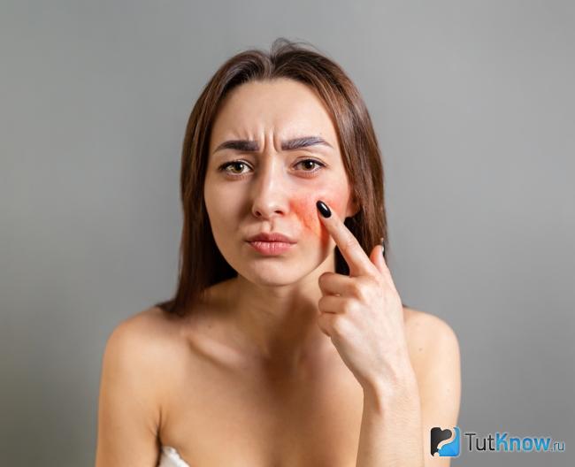 Купероз как противопоказание к применению зеленой глины