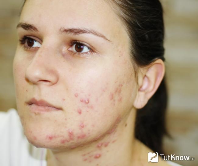 Гнойные прыщи на шее